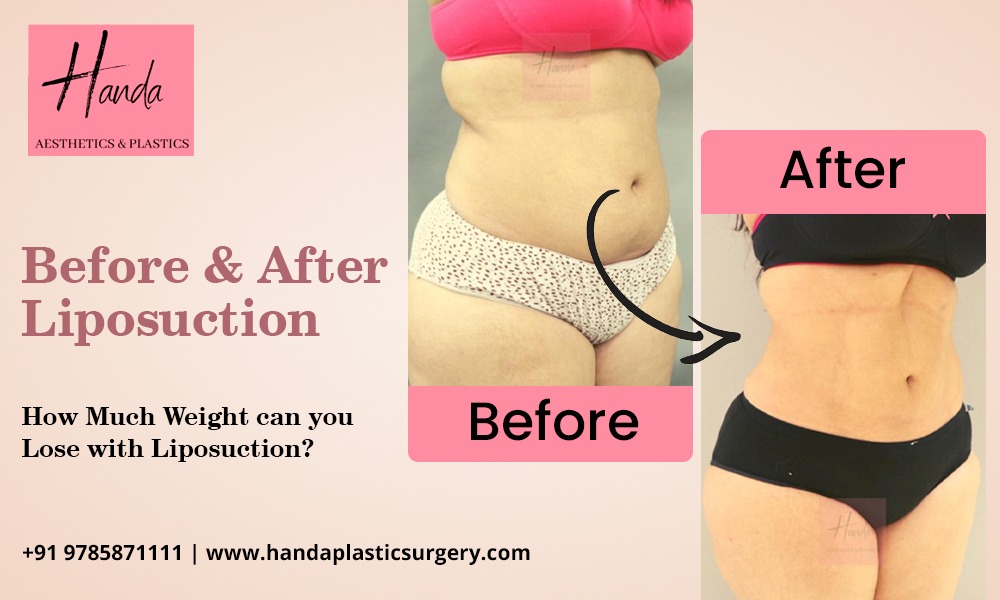 Read more about the article Before and After Liposuction: How much weight can you lose with liposuction?