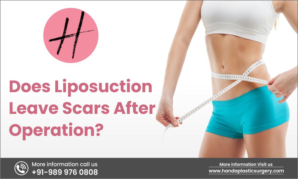 Read more about the article Liposuction Scars: Does Liposuction Leave Scars After Operation?