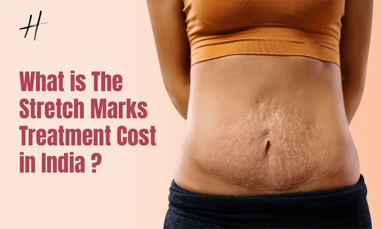 Read more about the article Stretch Marks Treatment Cost In India