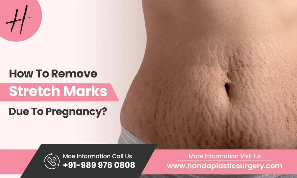 Read more about the article How To Remove Stretch Marks Due To Pregnancy?