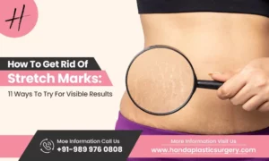 Read more about the article How To Get Rid Of Stretch Marks: 11 Ways To Try For Visible Results