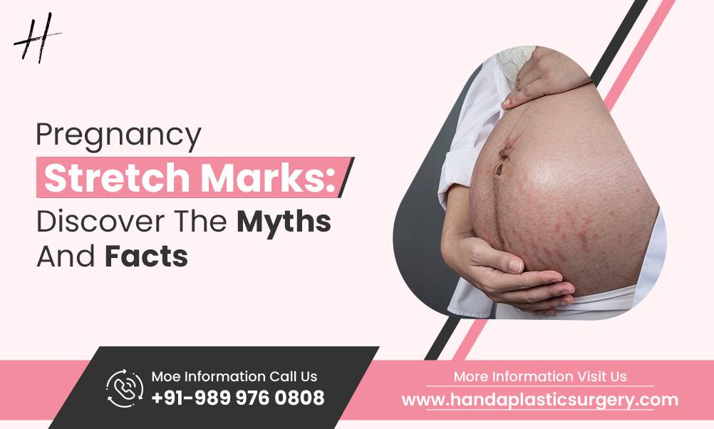 Read more about the article Pregnancy Stretch Marks: Discover The Myths And Facts