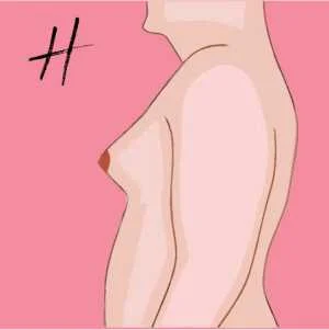 Stage or Grade 2 Gynecomastia