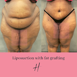 Liposuction With Fat Grafting
