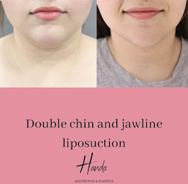 Double Chin & Jawline Liposuction