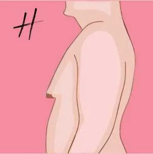 Stage or Grade 3 Gynecomastia