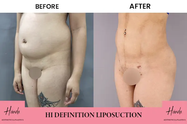 Before And After Liposuction