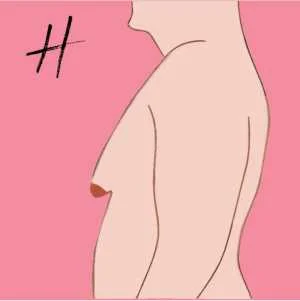 Stage or Grade 4 Gynecomastia