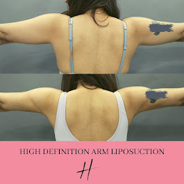 Hi Definition Arm Liposuction