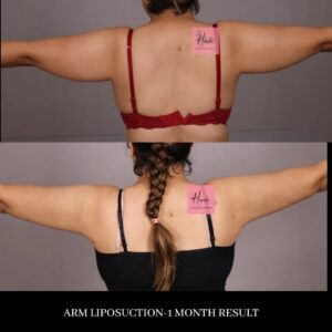 Arm Liposuction Before And After- Patient 3