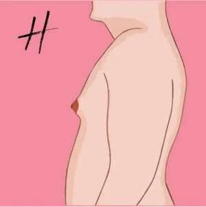 Stage or Grade 1 Gynecomastia