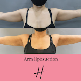 Arm Liposuction Before And After- Patient 1