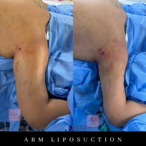 Arm Liposuction Before And After- Patient 2