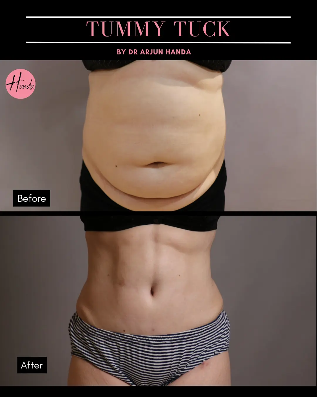 Tummy Tuck (Full Abdominoplasty) before and after — Handa Aesthetics