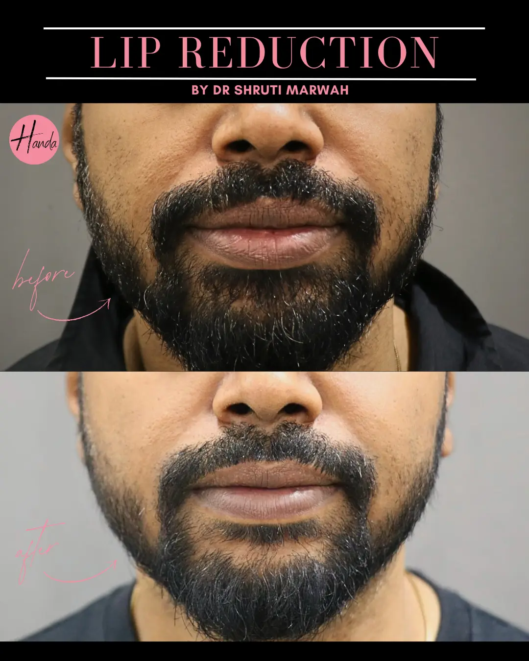 LIP REDUCTION before and after — Handa Aesthetics