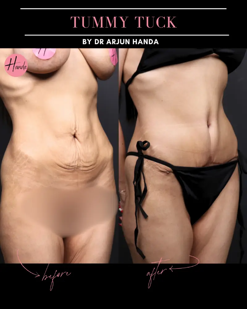 Tummy Tuck (Full Abdominoplasty) before and after — Handa Aesthetics
