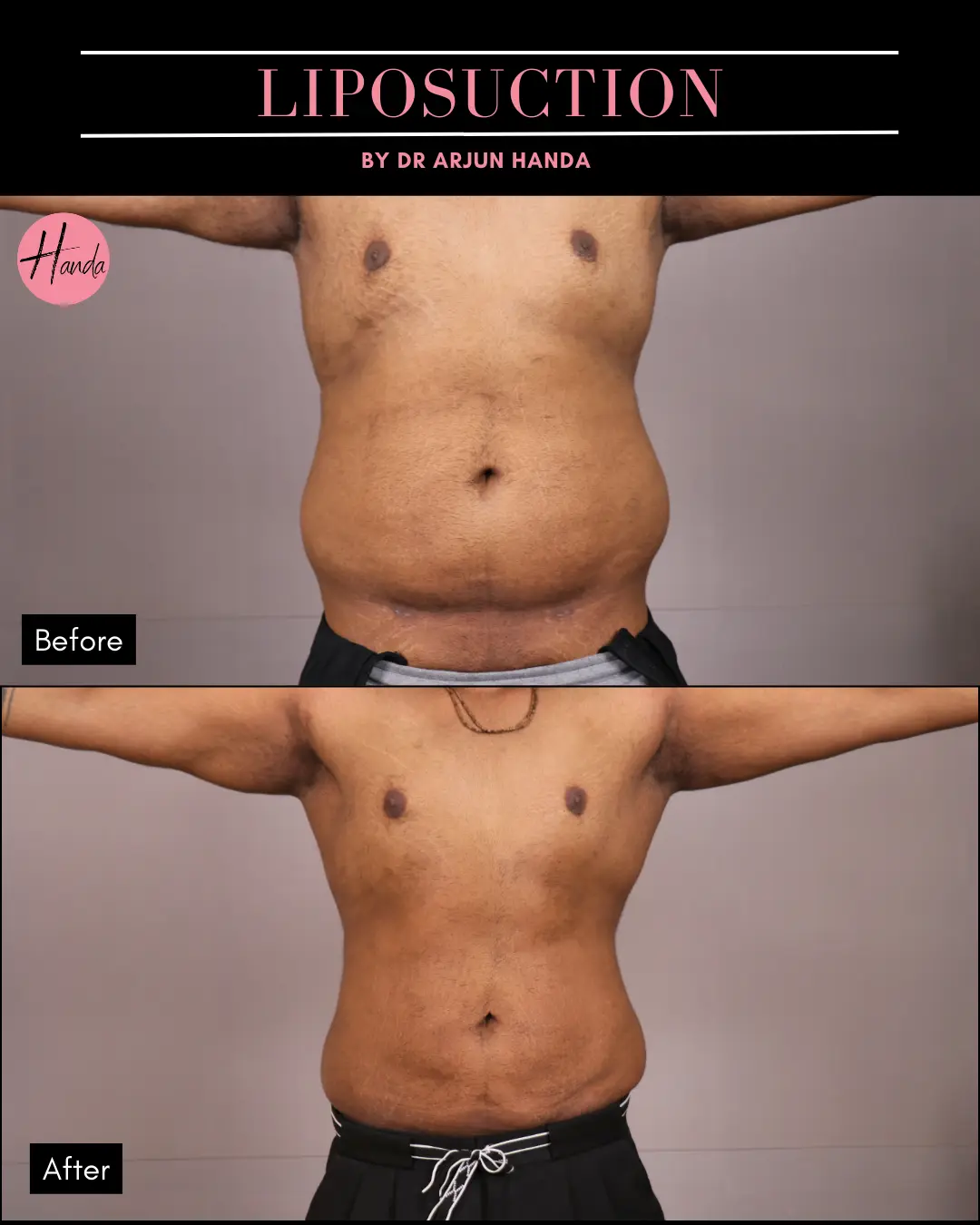 Liposuction before and after — Handa Aesthetics