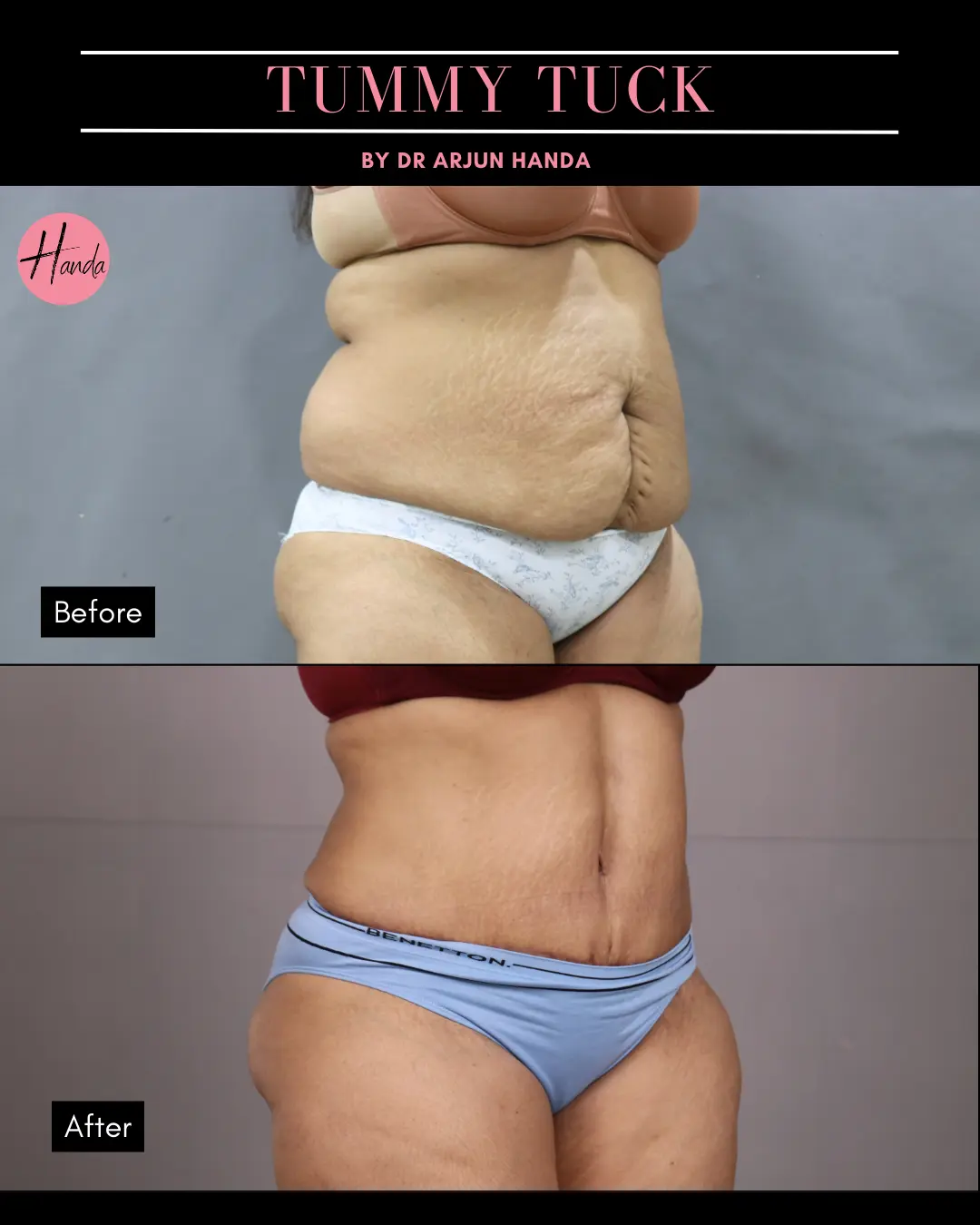 Tummy Tuck (Full Abdominoplasty) before and after — Handa Aesthetics