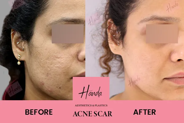 Body Contouring before and after — Handa Aesthetics