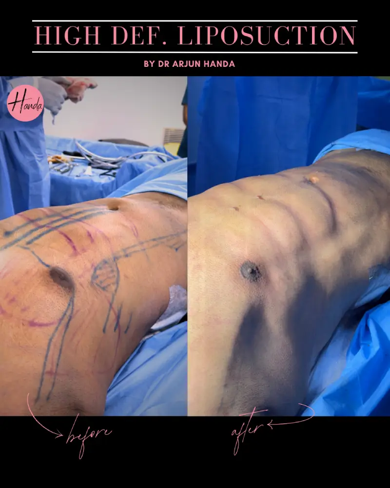 Liposuction before and after — Handa Aesthetics