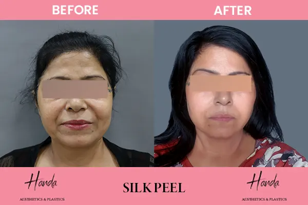 Body Contouring before and after — Handa Aesthetics