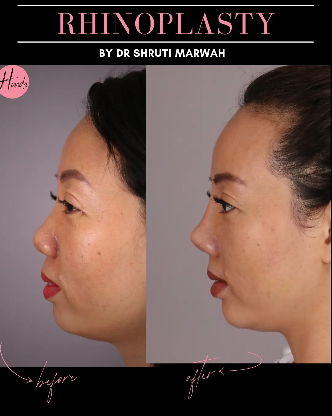 RHINOPLASTY before and after — Handa Aesthetics