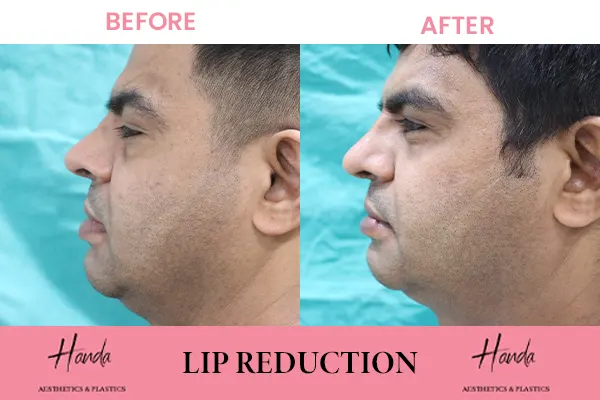 LIP REDUCTION before and after — Handa Aesthetics