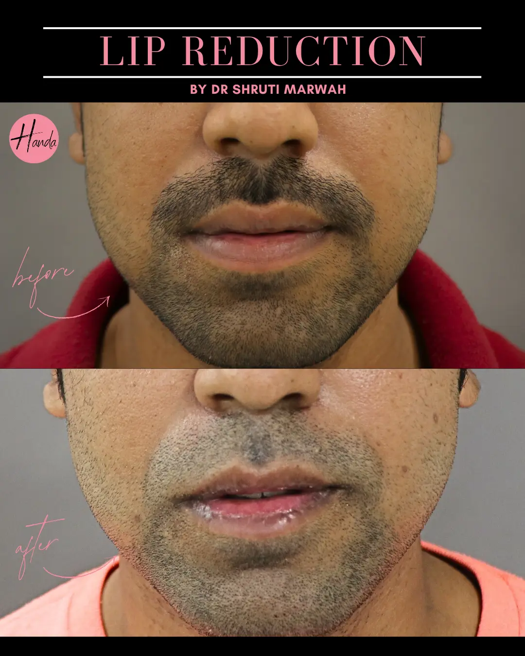 LIP REDUCTION before and after — Handa Aesthetics