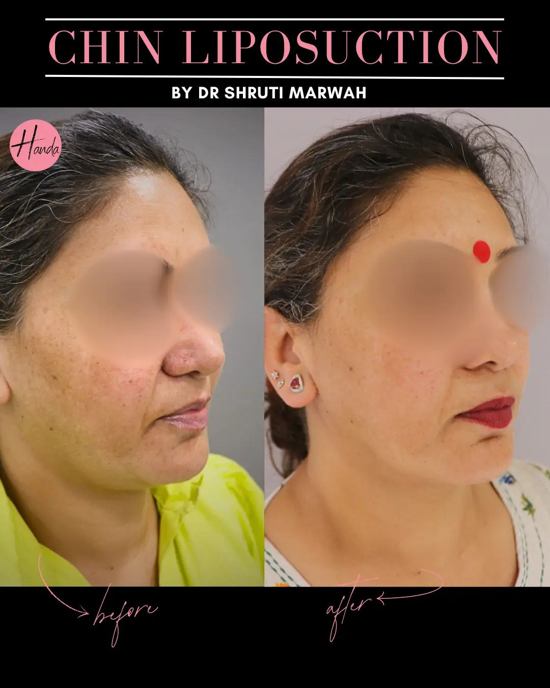 CHIN & JAWLINE LIPOSUCTION before and after — Handa Aesthetics