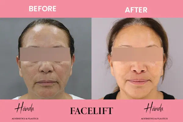 FACE LIFT before and after — Handa Aesthetics