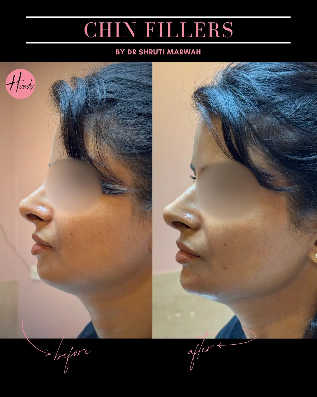 CHIN & LIP FILLERS before and after — Handa Aesthetics