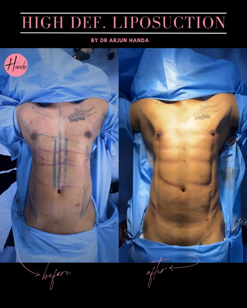 Liposuction before and after — Handa Aesthetics