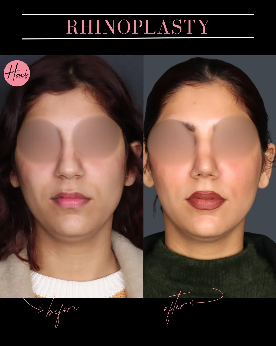 RHINOPLASTY before and after — Handa Aesthetics