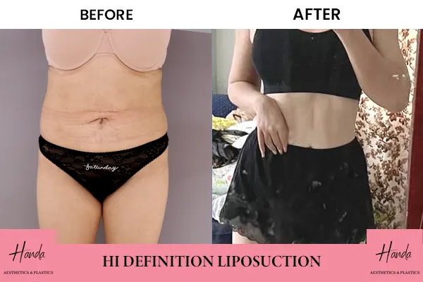 Liposuction before and after — Handa Aesthetics