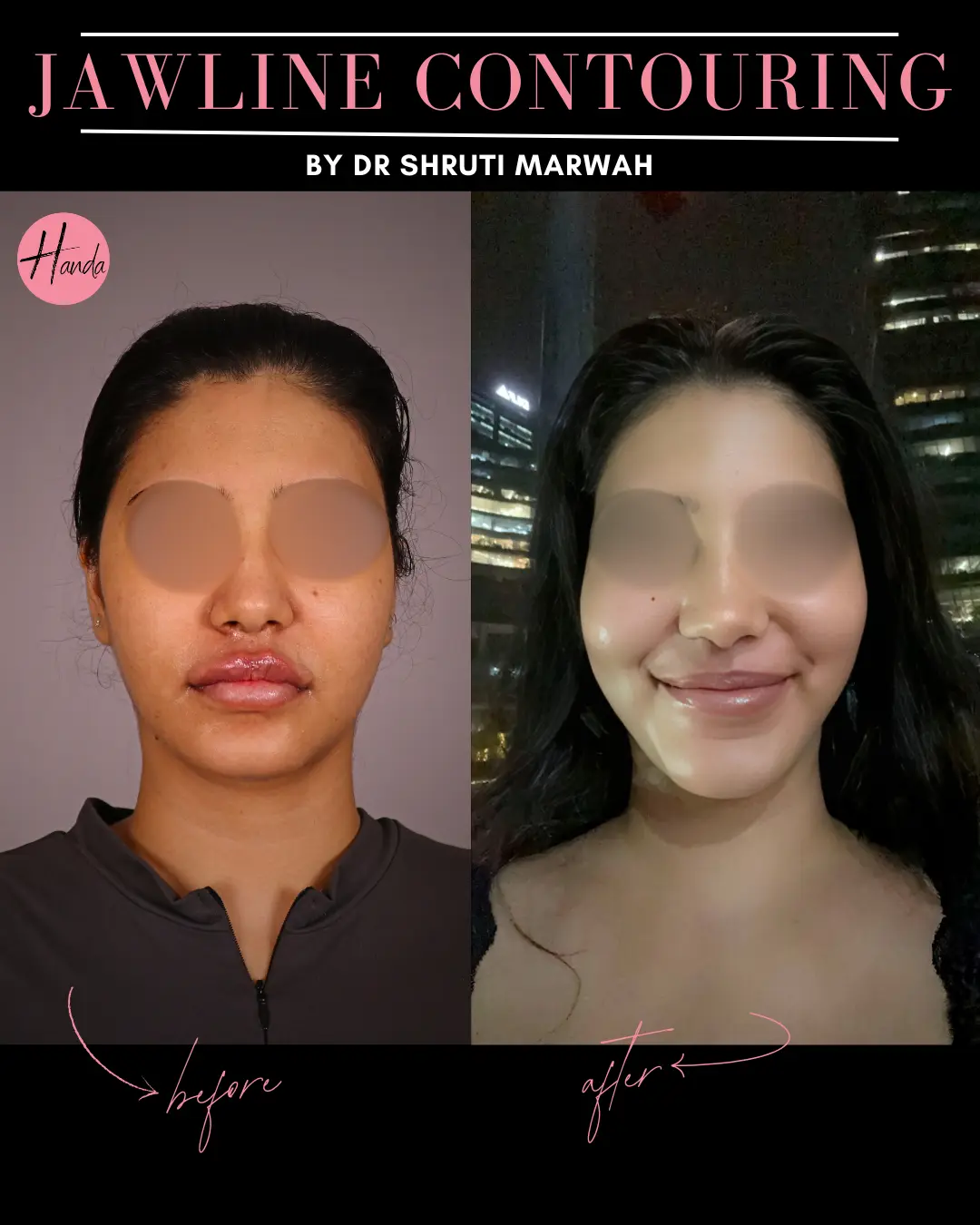 CHIN & JAWLINE LIPOSUCTION before and after — Handa Aesthetics