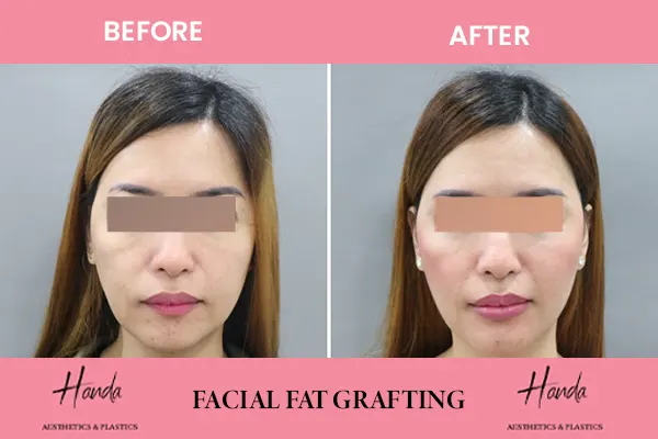 FACIAL FAT GRAFTING before and after — Handa Aesthetics