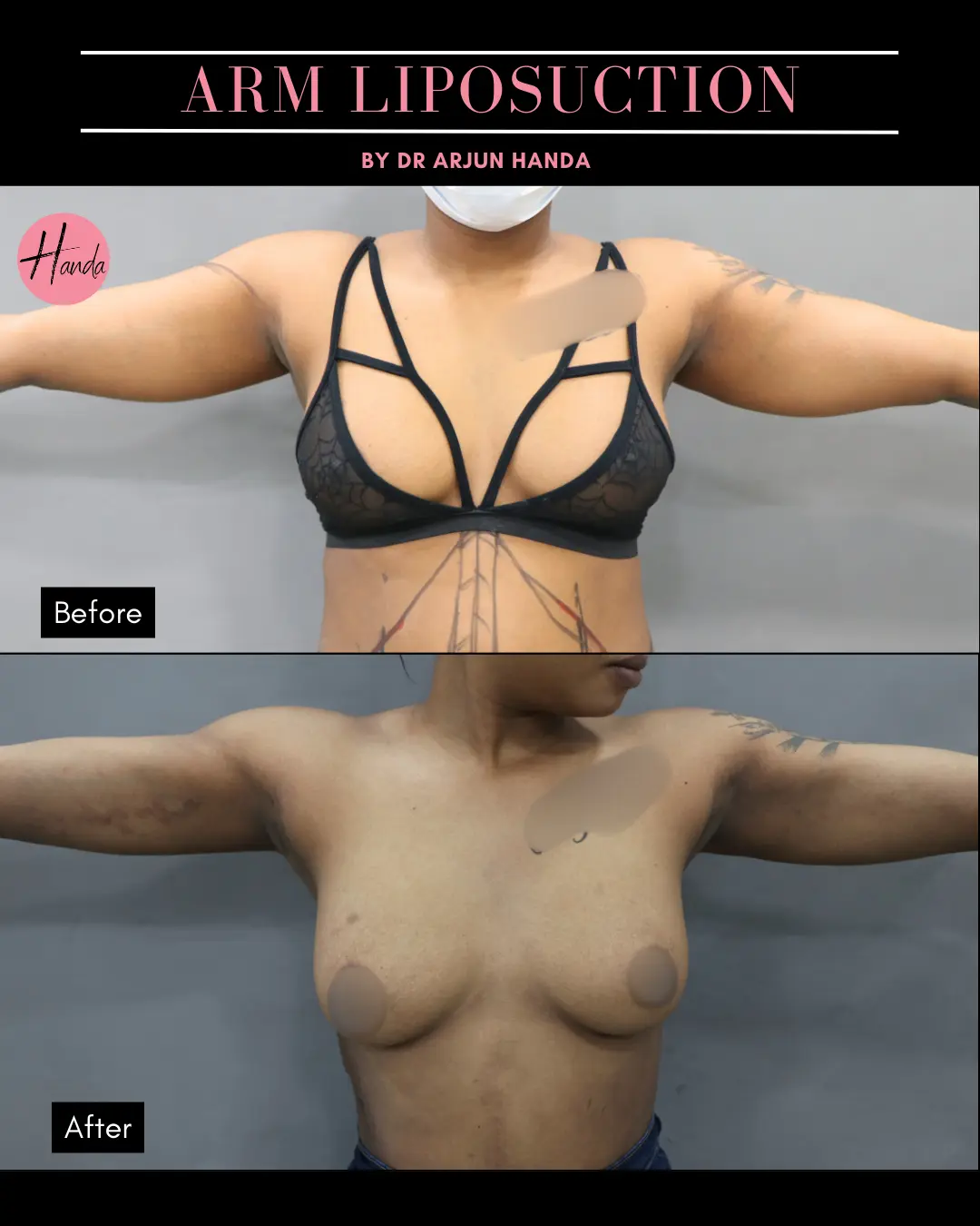 Arms & Thighs Lift before and after — Handa Aesthetics