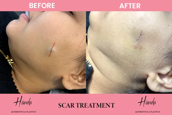 Body Contouring before and after — Handa Aesthetics