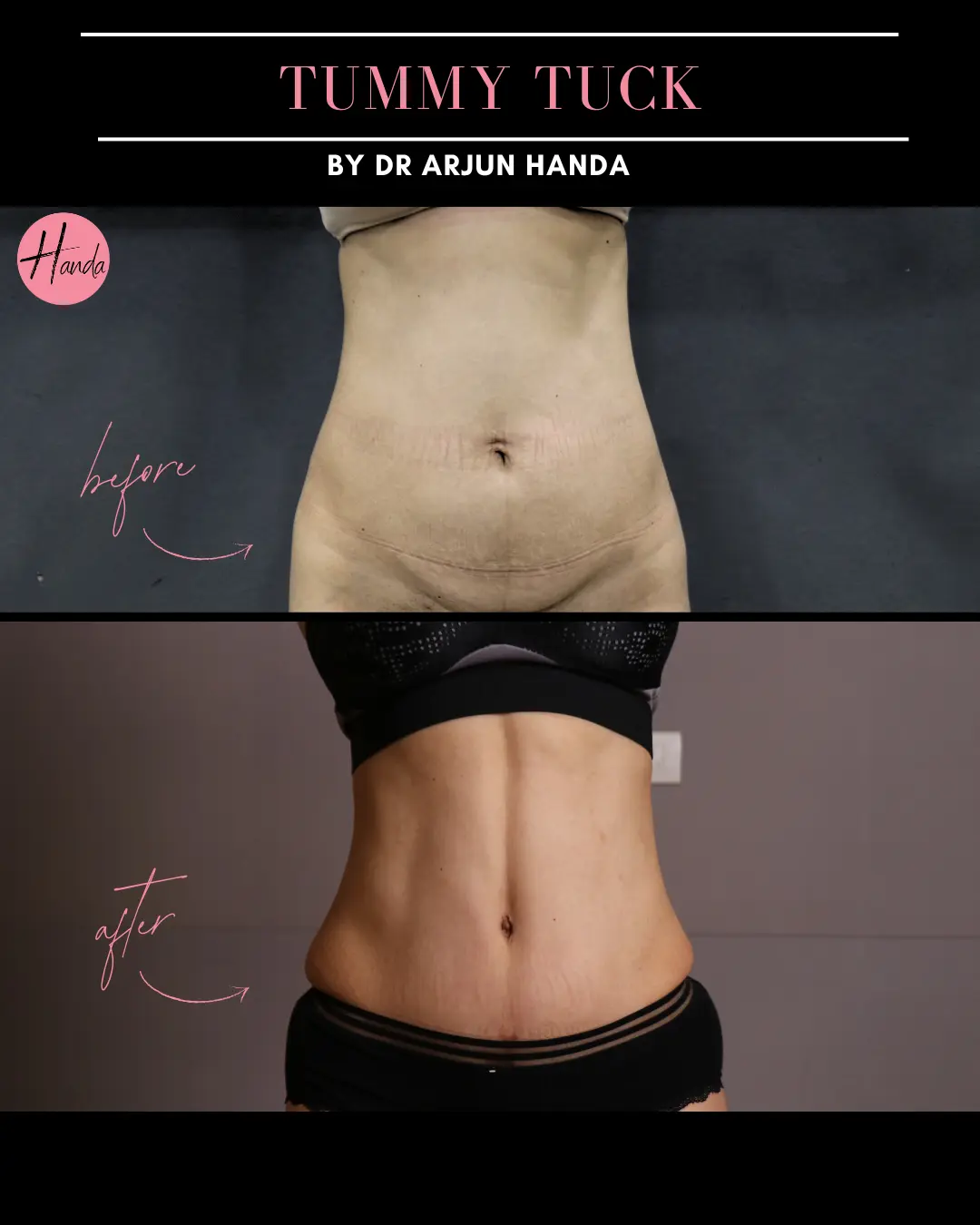Tummy Tuck (Full Abdominoplasty) before and after — Handa Aesthetics