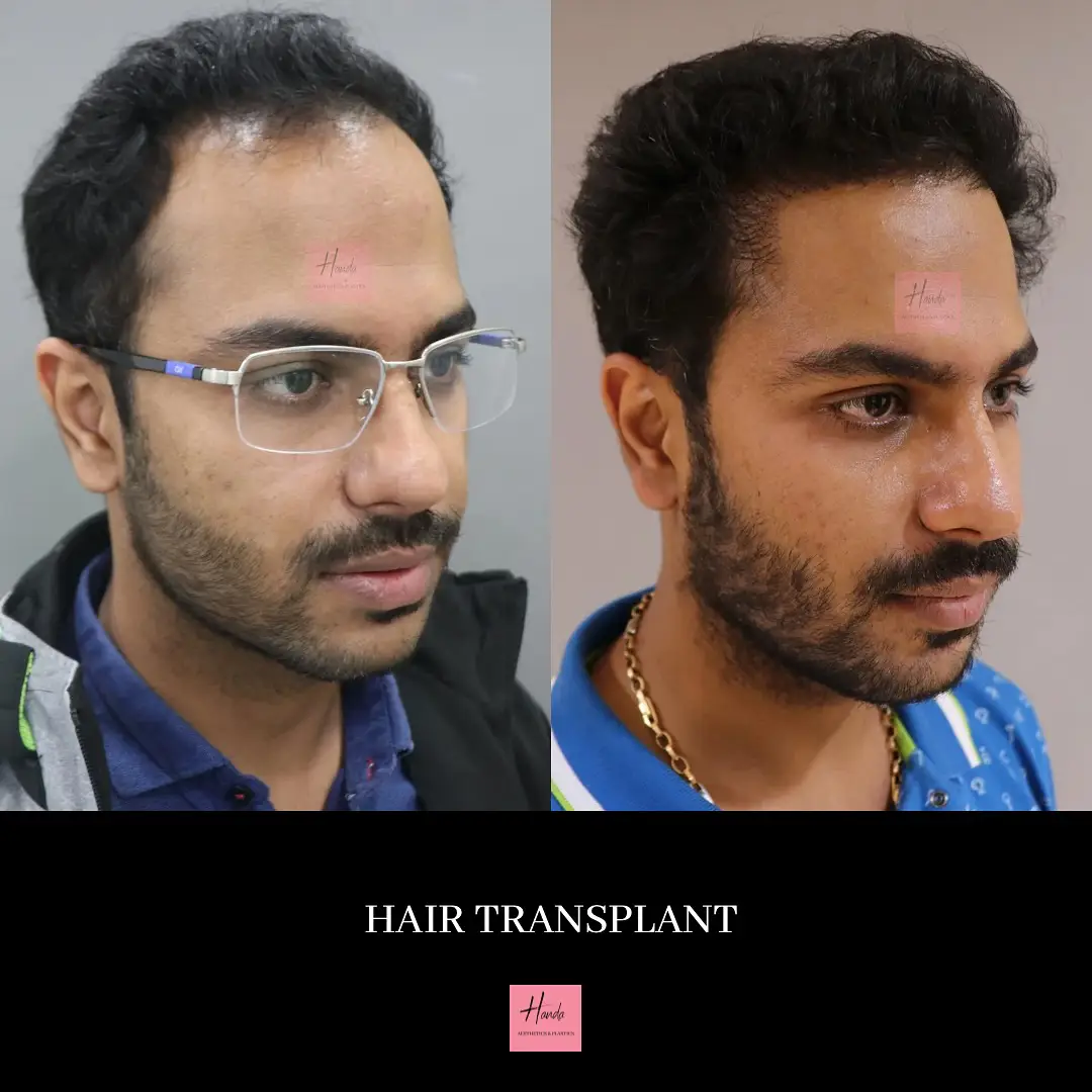 Hair Transplant before and after — Handa Aesthetics