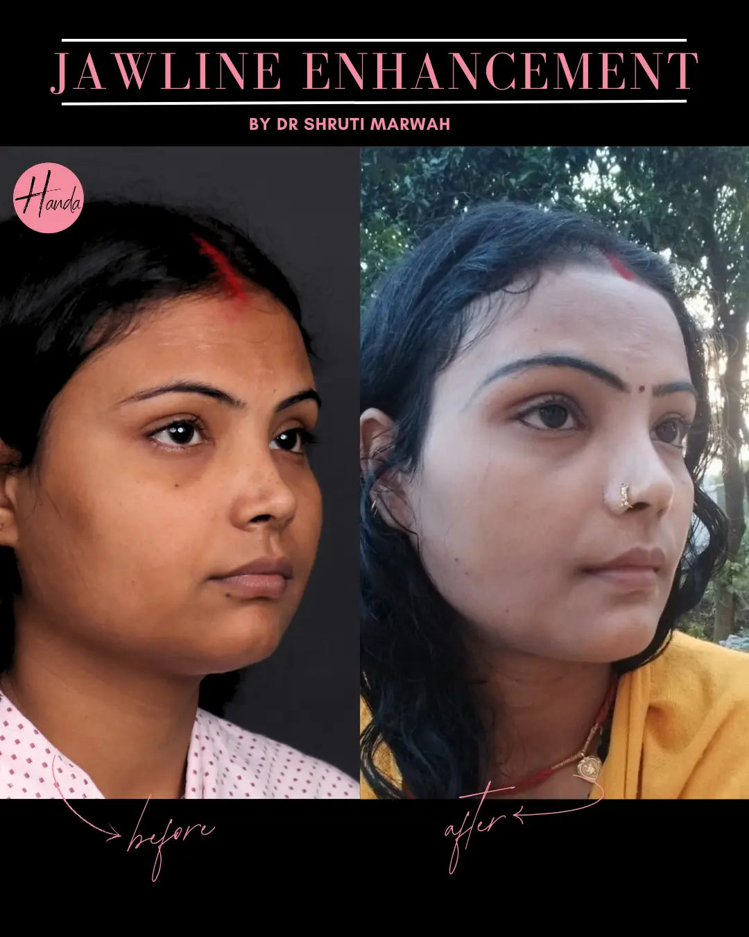 CHIN & JAWLINE LIPOSUCTION before and after — Handa Aesthetics