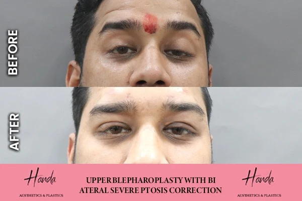 Face before and after — Handa Aesthetics
