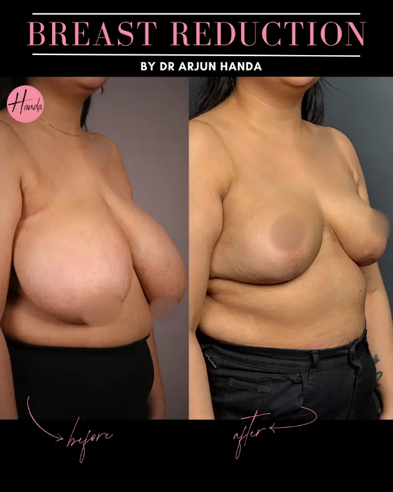 BREAST REDUCTION AND LIFT before and after — Handa Aesthetics
