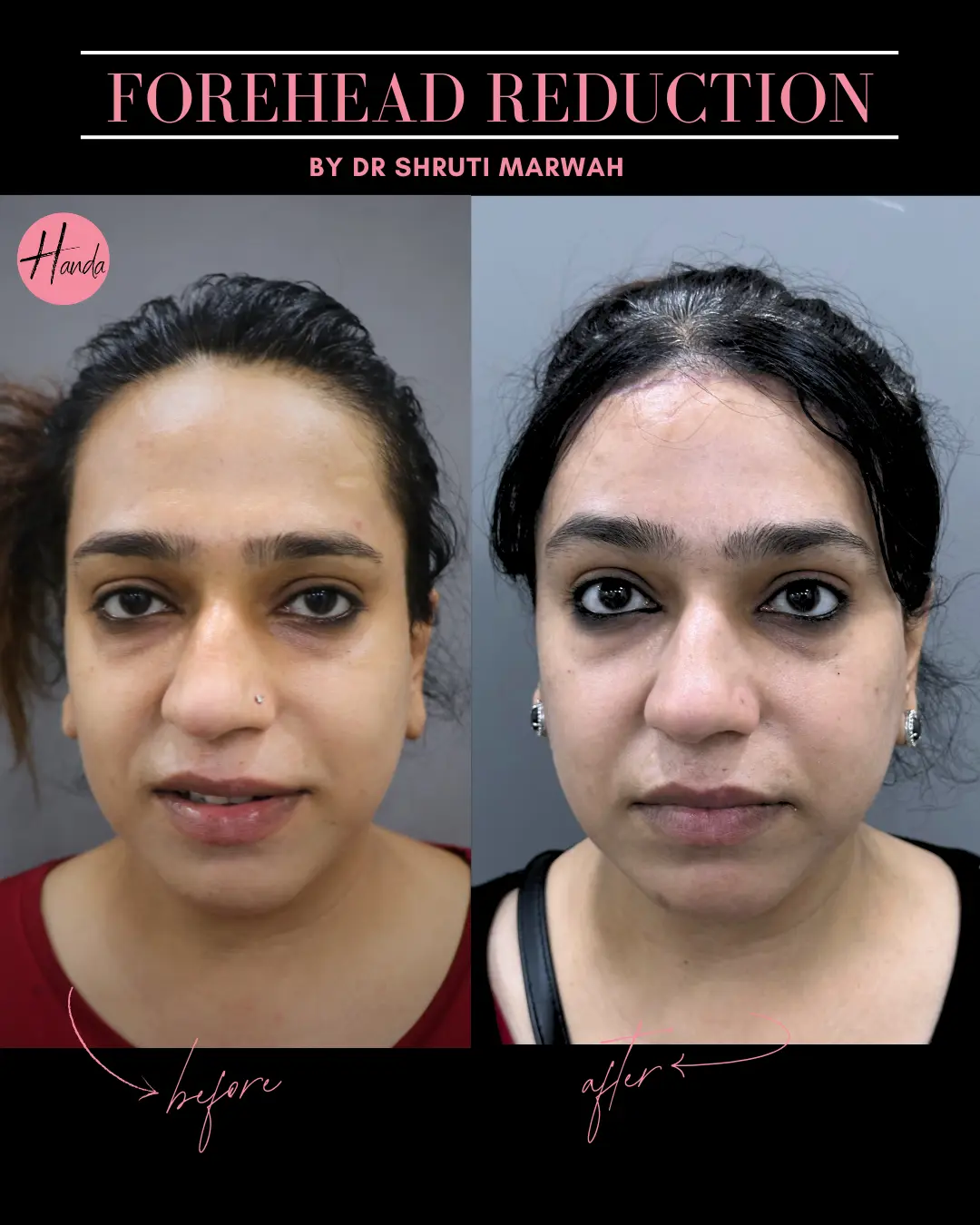 FOREHEAD REDUCTION before and after — Handa Aesthetics