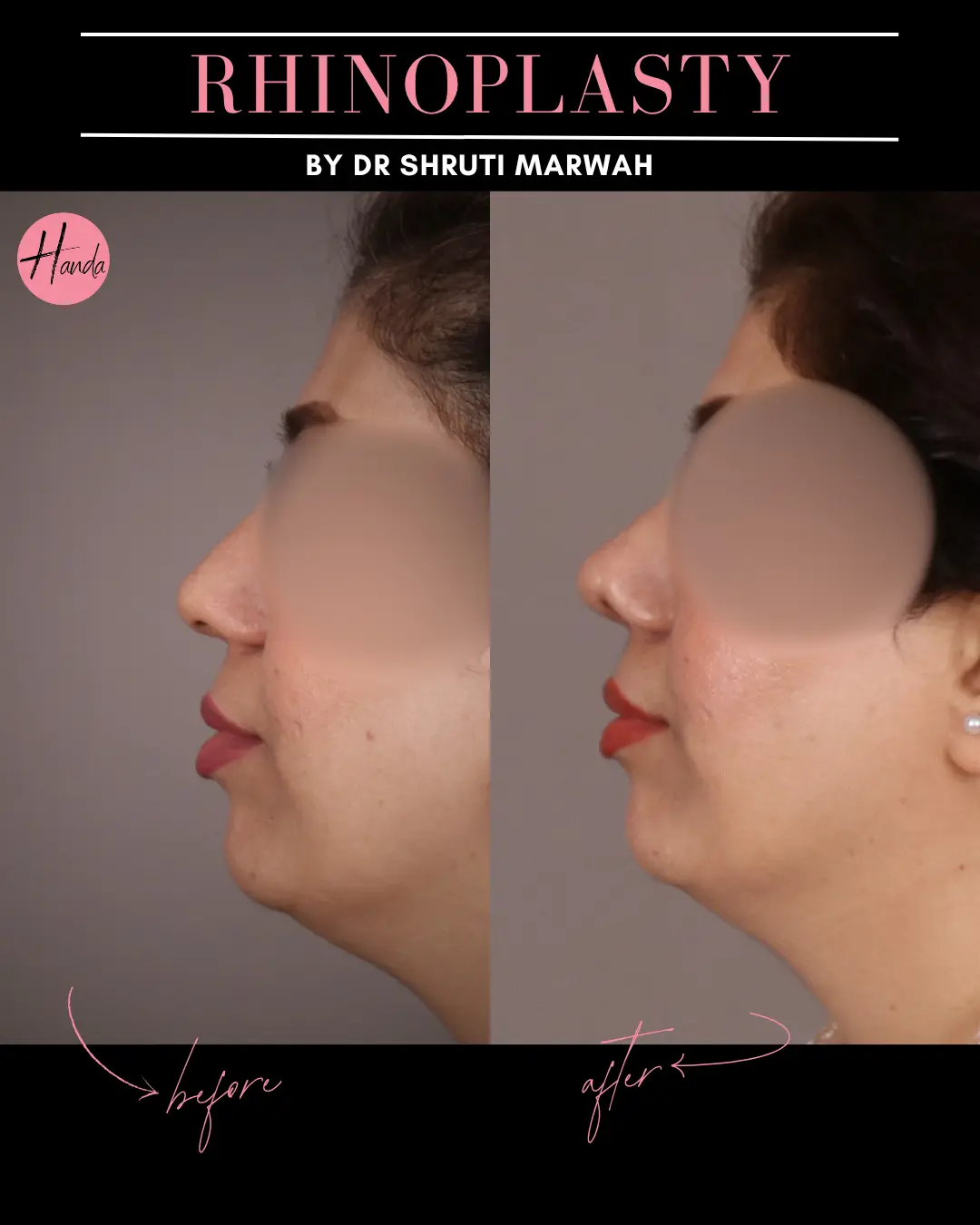 RHINOPLASTY before and after — Handa Aesthetics