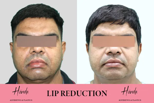 LIP REDUCTION before and after — Handa Aesthetics