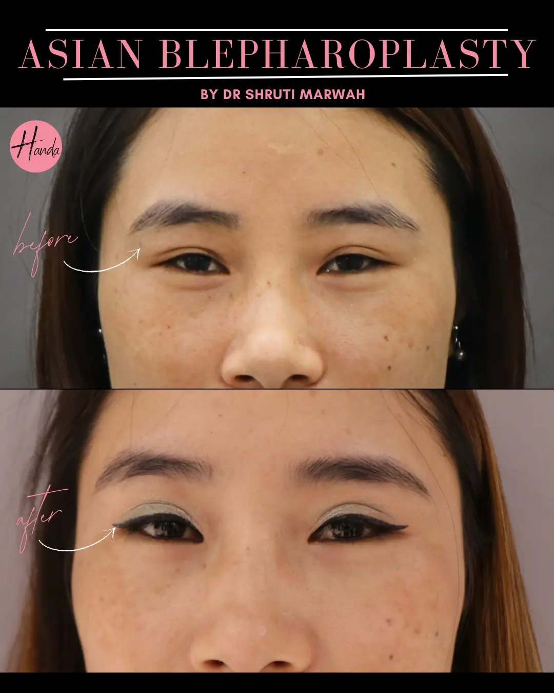 ASIAN BLEPHAROPLASTY before and after — Handa Aesthetics