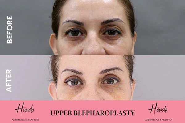 Face before and after — Handa Aesthetics