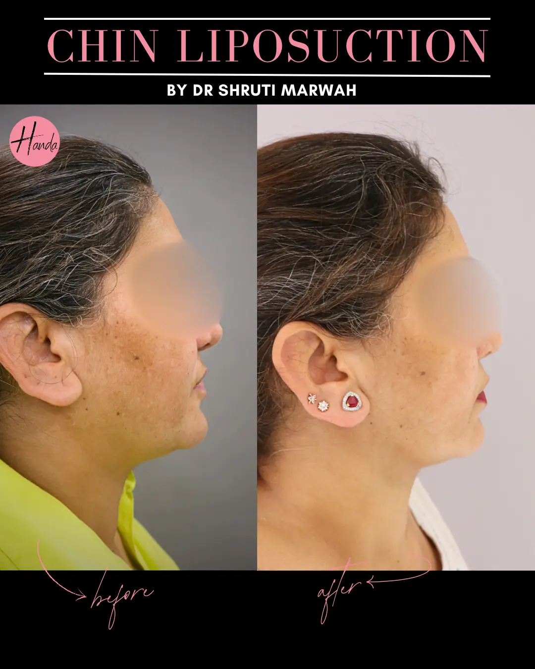 CHIN & JAWLINE LIPOSUCTION before and after — Handa Aesthetics