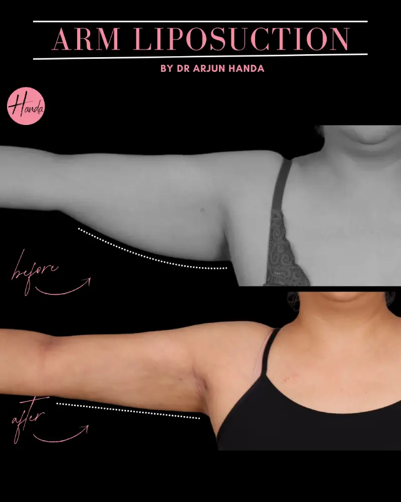 Arms & Thighs Lift before and after — Handa Aesthetics